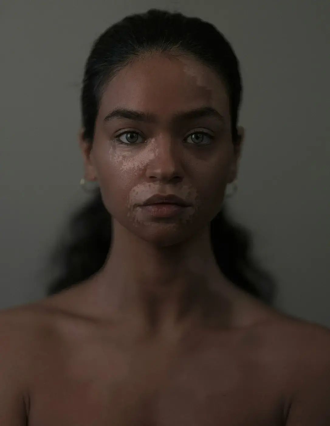 Foto 2 Vitiligo Models